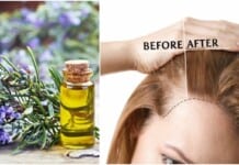 What Causes Baldness in Women? Symptoms, Solutions and Treatments